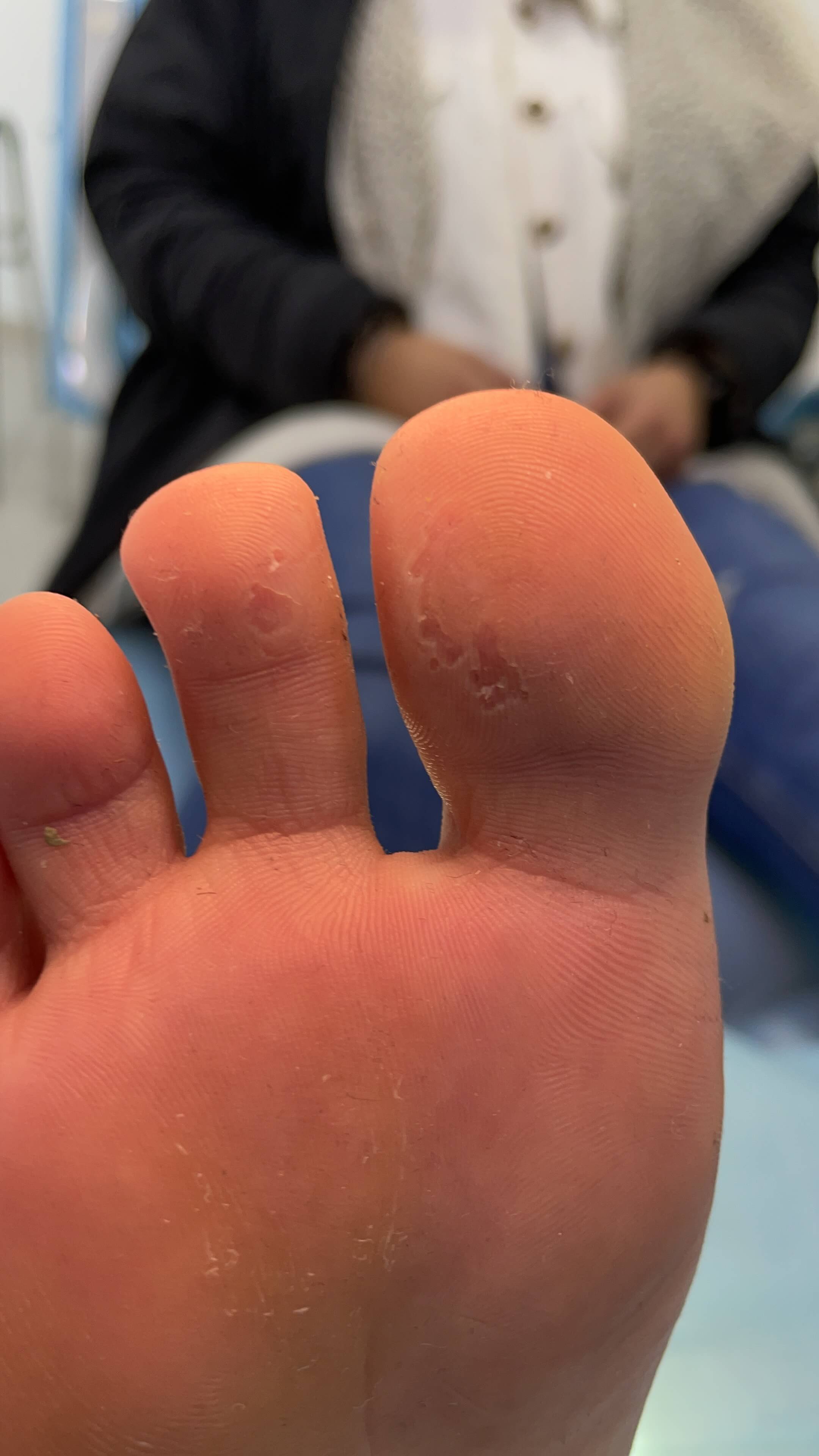 dolor-pie-metatarsalgia