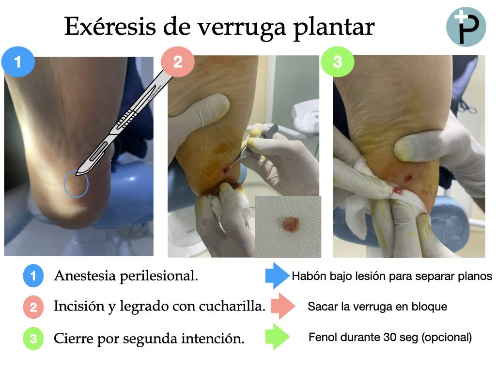 eliminacion-de-verruga-plantar-o-papiloma