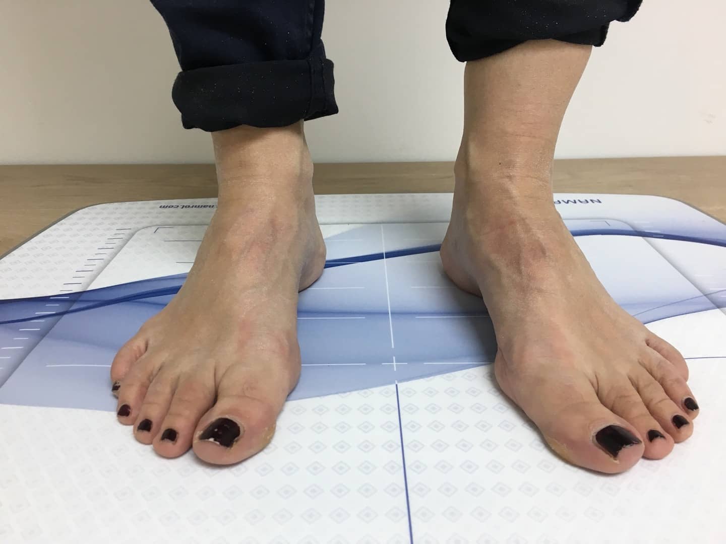 fascitis-plantar