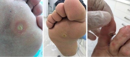 hiperqueratosis