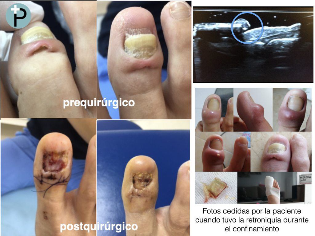 retroniquia-de-larga-evolucion