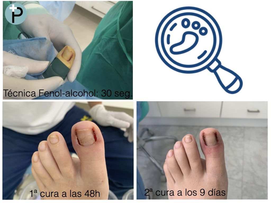 tecnica-fenol-alcohol