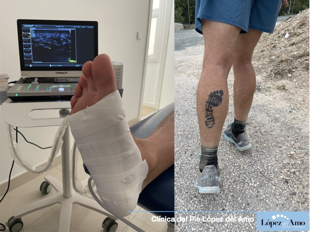 tratamiento-para-fascitis-plantar